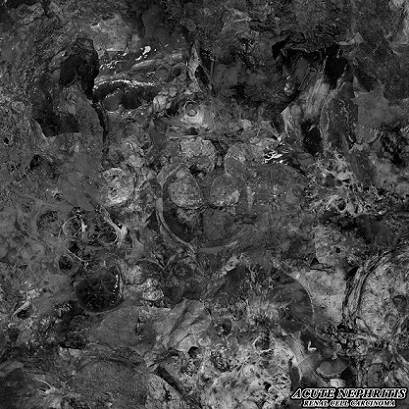 Renal Cell Carcinoma